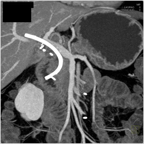 Ampullary Cancer With Common Bile Duct Cbd Stent Pancreas Case