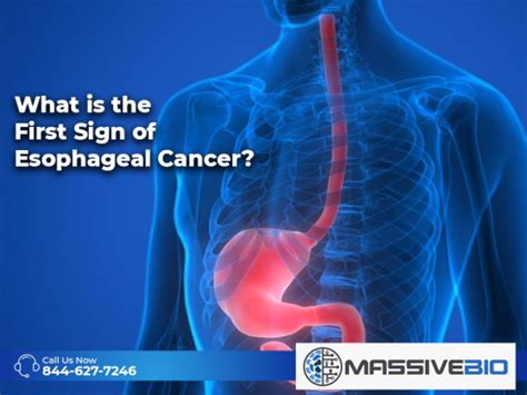 Oesophagus Cancer