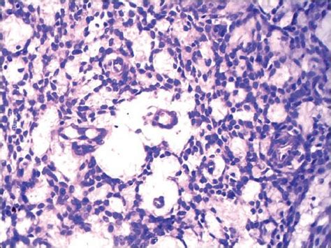 Photomicrograph Showing Areas Of Sex Cord Like Differentiation H And Download Scientific