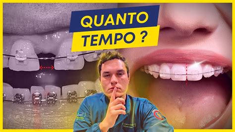 Quanto Tempo Demora Para Crescer Um Dente