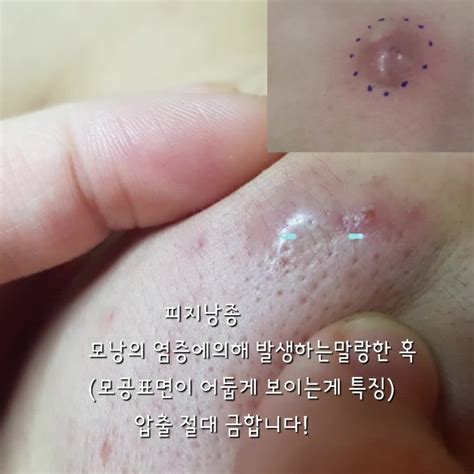 이런염증은어떻게 처리해야될까요 피지낭종구미피지낭종피부낭종성여드름구미여드름관리잘하는곳흉터예방만성염증홈케어문제성피부