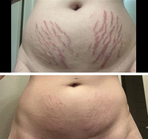 [banda] Stretch Mark Reduction With Tretinoin 05 Cream R Skincareaddiction