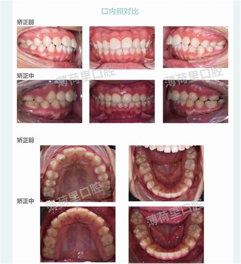 厦门青少年正畸案例分享 牙齿内收排齐 知乎