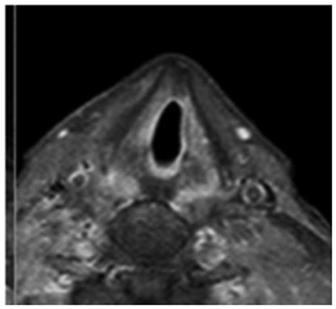 Magnetic Resonance T2 Weighted Axial Image Demonstrating Complete Download Scientific Diagram