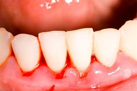 Swollen Gums Are One Of The First Signs Of Gingivitis If You Dont