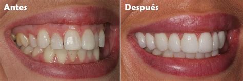 Cirugía de reposición labial Solución Dental Lima Perú