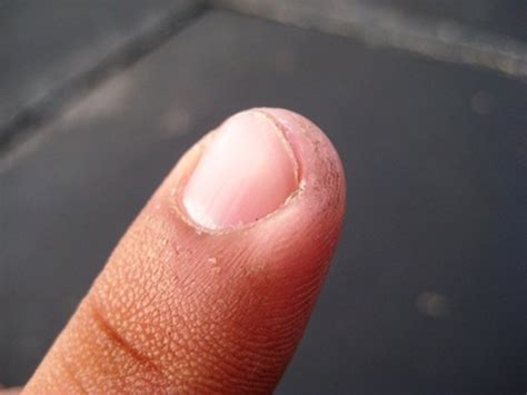 How To Treat An Ingrown Fingernail