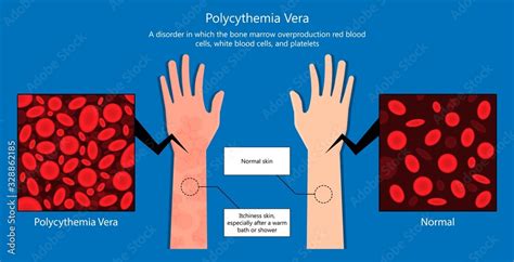 Symptoms Of Polycythemia Vera | Hot Sex Picture