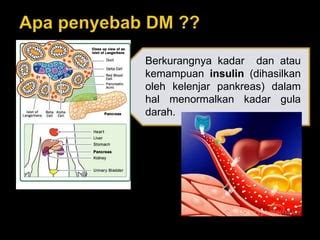 DIABETES MELLITUS Kenali Dan Cegah Awam 2015 Ppt