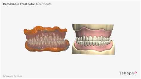 Dentures - Removable Prosthetic Treatments – 3Shape Design Services