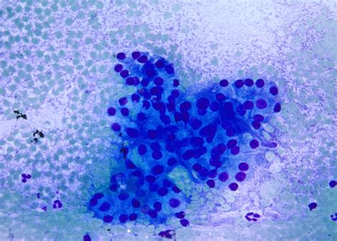 Pathology Outlines Cytology