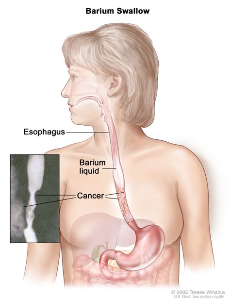 Esophageal Cancer Barium Swallow