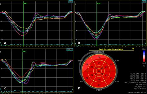 Normal Values Of Longitudinal Strain Panels A B And C Show Strain