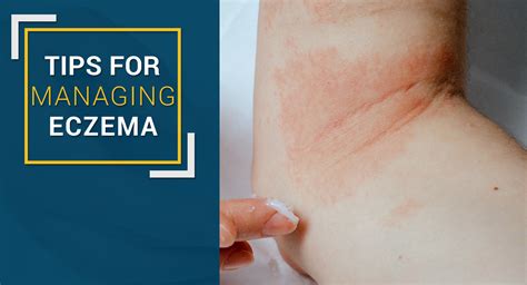 6 Simple and Effective Tips for Managing Eczema