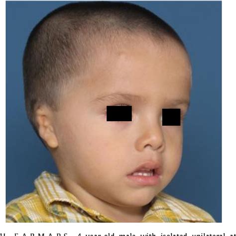 Figure 1 From HEAR MAPS A Classification For Congenital Microtia