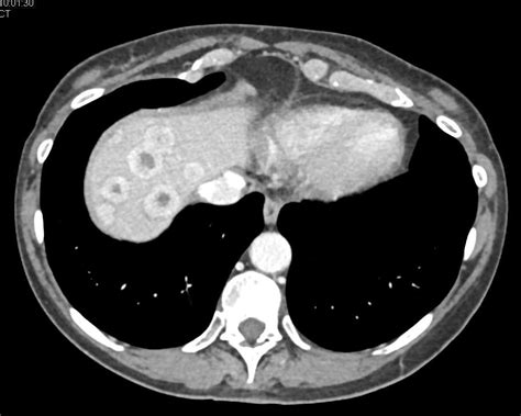 Metastatic Carcinoid Tumor To The Liver Liver Case Studies Ctisus