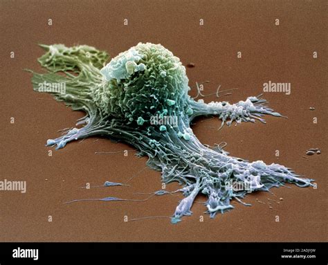 Ovarian Cancer Cell Coloured Scanning Electron Micrograph Sem Of An Ovarian Cancer Cell This