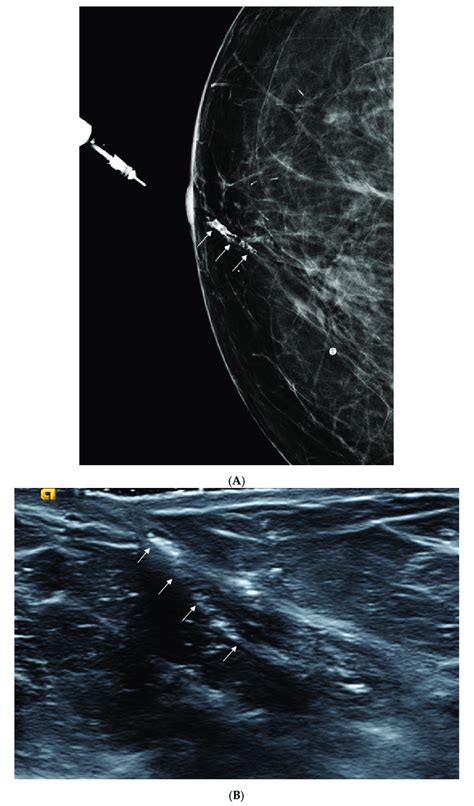 A 79 Year Old Woman With A Pathological Diagnosis Of Ductal Carcinoma