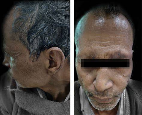 Chronic recalcitrant erythema nodosum leprosum: therapeutic dilemma and