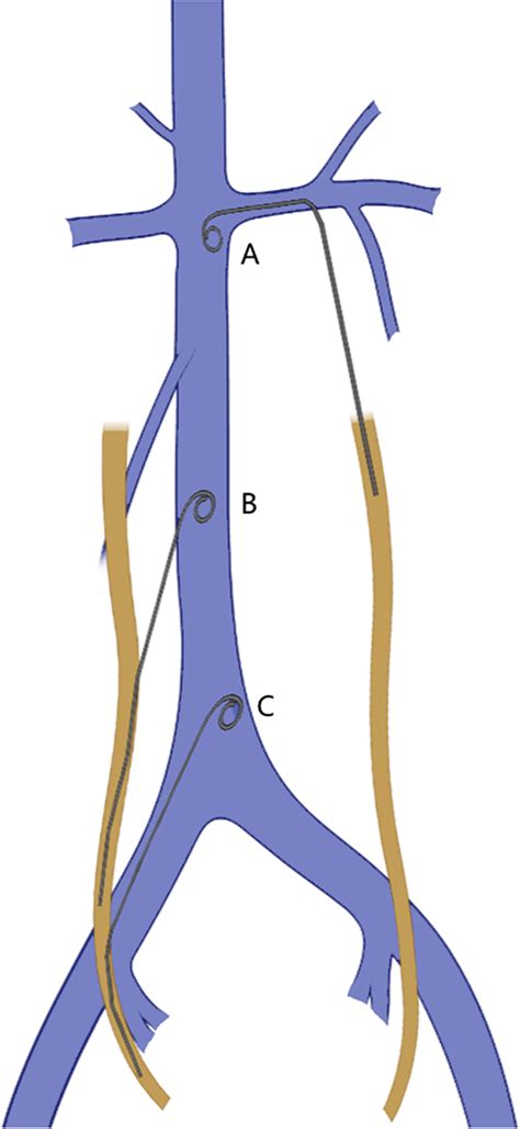 Common Pathways For Double J Stents Djss To Enter The Inferior Vena