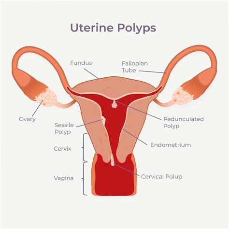 Uterine Polyps West Sussex Gynaecology