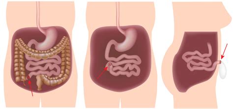 Surgery For Ibd Ibdrelief