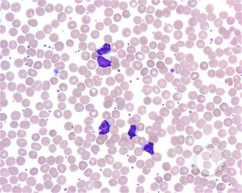 Peripheral smear clues for Bordetella pertussis