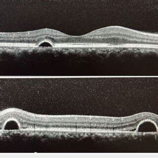 OCT Scan Across Macula Of Right A And Left B Eyes Showing