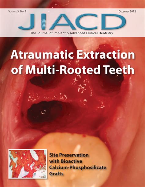 Atraumatic Extraction Of Multi Rooted Teeth Jiacd