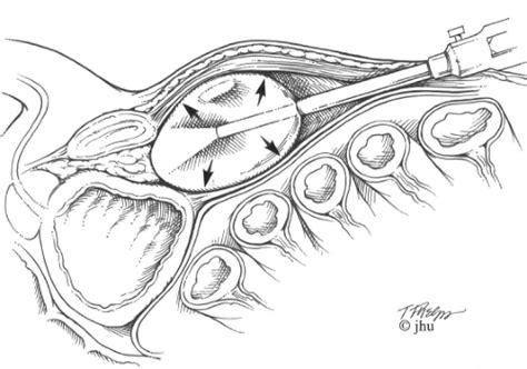 Retropubic Laparoscopic And Robotic Assisted Radical Prostatectomy