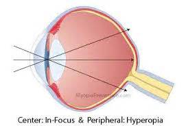 What S Happening To Our Vision Peripheral Defocus And Myopia