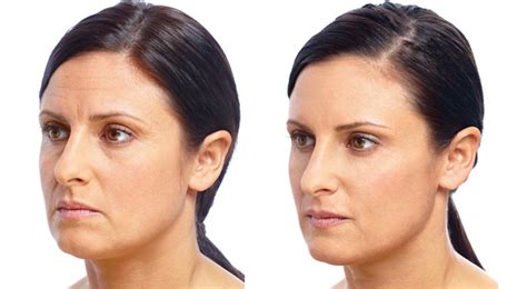 Liquid Facelift With Botox And Juvéderm In Santa Rosa