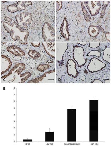 High Foxm1 Expression Is A Prognostic Marker For Poor Clinical Outcomes