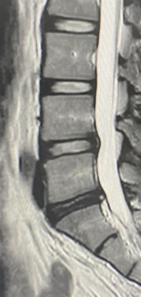 Mid 20s lower back MRI : r/backpain