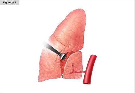 Lung Sequestration | Thoracic Key