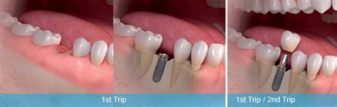 Same Day Dental Implants And One Day Implants