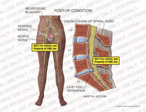 Post Op Condition 98104b32b Generic Medical Legal Exhibits A Division Of Mvi