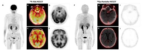 Bing–Neel Syndrome and Coexisting Pituitary Macroadenoma in a Patient