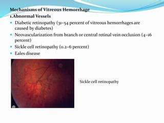 Vitreous hemorrhage | PPT