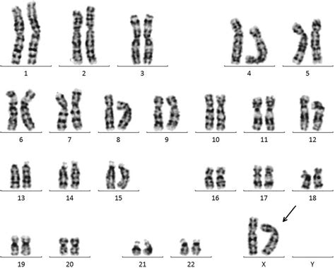 Chromosome Karyotype Of The Patient The Sex Chromosomes Of The Patient