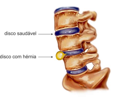 H Rnia De Disco O Que E Como Tratar Sa De Benessere Sa De