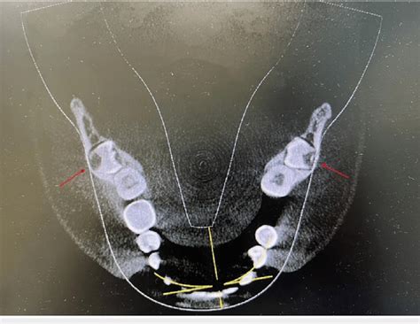 Cbct Of The Axial Section Showing The Root Of Not Completely