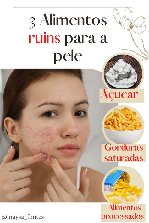 Alimentos Ruins Para A Pele Alimenta O Espinhas No Rosto Pele Acne