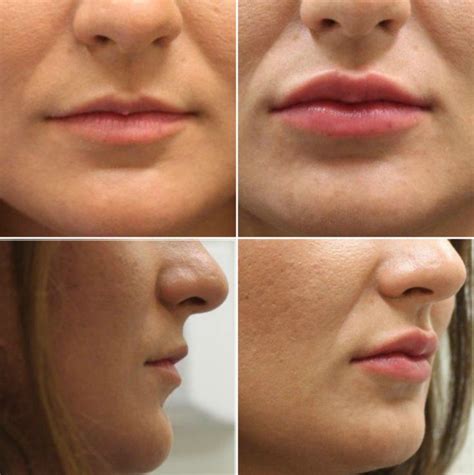 Volbella By Juvederm Is An Injectable Filler Used To Enhance Lip