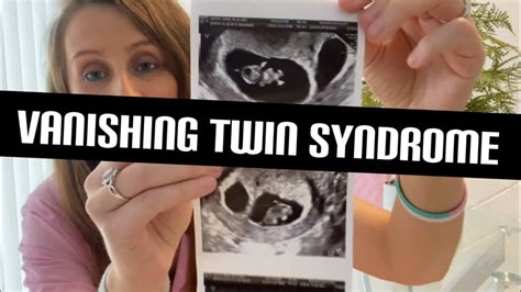 Vanishing Twin Syndrome Our 4th Miscarriage Same Sex Couple Ivf