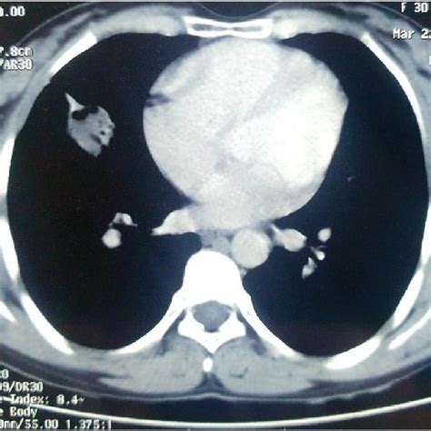 Cect Chest Axial Image Shows A Solid Cystic Lesion In The Right Middle