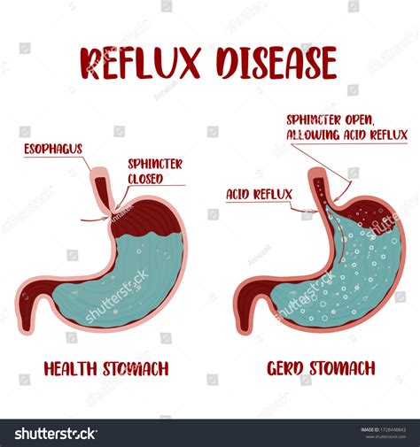 Heartburn Gastroesophageal Reflux Disease Gerdgastritis Acid Stock