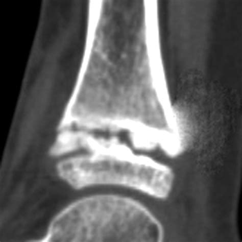 Resection Of A Physeal Bar Under Computer Assisted Guidance Bone Joint