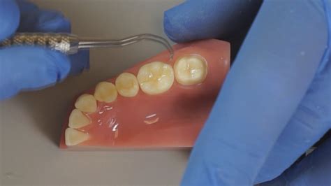 Zirconia Crown Cementation - Insure Resin Cement - YouTube