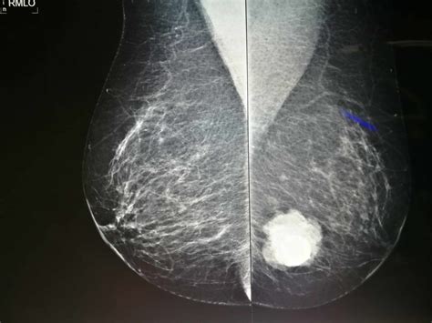 Breast Calcifications Symptoms Causes And Treatment Apollo Hospitals